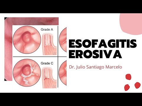 Esofagitis Erosiva