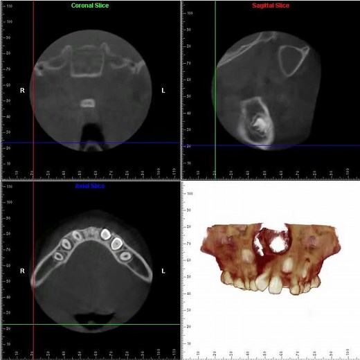 Cleft Palate - 3D Cone Beam CT Scan and Animation by SmartScan Imaging of Orange