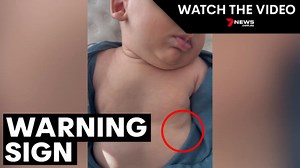 What chest retractions look like