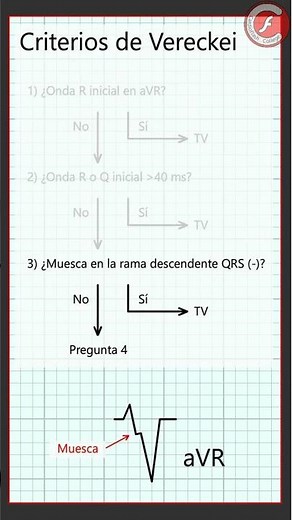 28 - Criterios de Verekei para taquicardias de QRS ancho