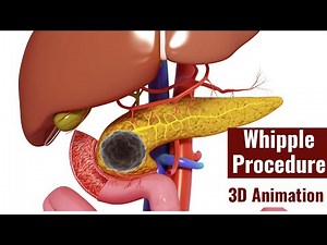 Whipple Procedure | 3D animation of Whipple Procedure