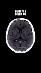 How to read a brain CT scan. #Medicine #Doctor #Radiology #Brain #Neuro | Dr.Z Neurosurgery