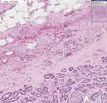 Histopathology Prostate --Adenocarcinoma (Gleason grade 3)