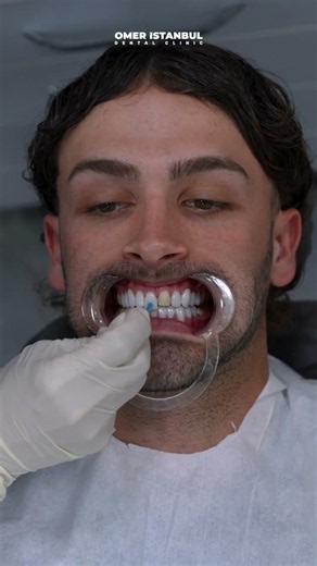 The Process Behind the Perfect Smile | The Art of Veneer Placement at Omer Istanbul