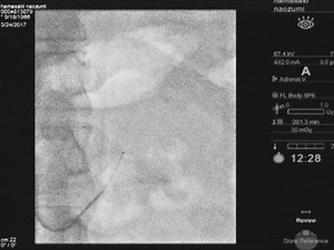 A Novel Method: Super-selective Adrenal Venous Sampling