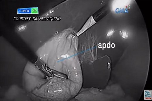 ALAMIN: Mga sintomas ng gallstones o bato sa apdo, at paano ito maiiwasan