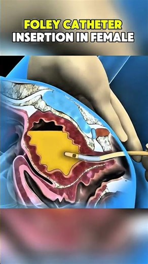 Foley Catheter insertion in female |3D ANIMATIONS| #FoleyCatheterInsertion#Catheter#fyp