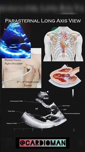Parasternal long axis (PLAX) view🫀#echocardiography