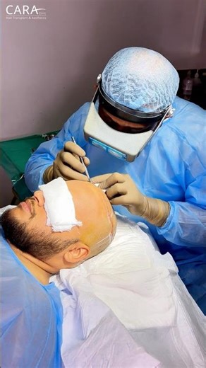The Exact Process That Stopped His Hair Loss #hairtransplant #beforeandafter