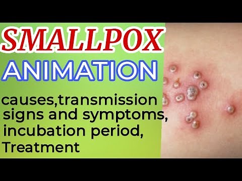 Smallpox symptoms | smallpox treatment | small pox | smallpox animation | smallpox virus | 3D