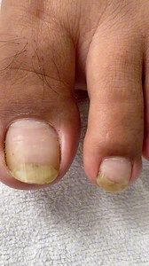 Sa sobrang hab@ bumaon na Ang kuko #ingrowntoenail #kutkotqueen #satisfying #pedicure | Kutkot Queen