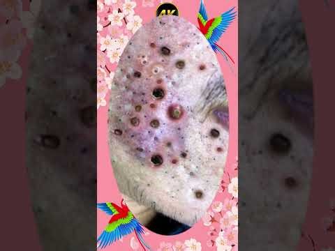 Blackheads Removal #157 | Acne Treatment and Very Satisfying Satisfying Pimple pop #blackheads