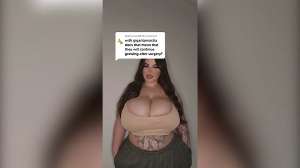 My P-cup boobs won’t stop growing due to rare condition — and it costs me $170 to buy one bra