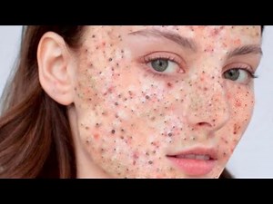 Pimple Popper & Blackhead Removal | Best Pimple Popping Compilation 2024 Video 17