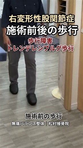 右変形性股関節症｜施術前後の歩行｜トレンデレンブルグ歩行