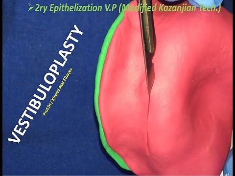 Preprosthetic Surgery 4 (Vestibuloplasty)