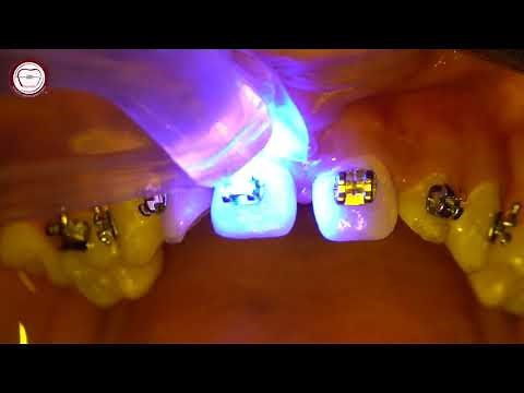 Braces bonding step by step in orthodontics & wire insertion