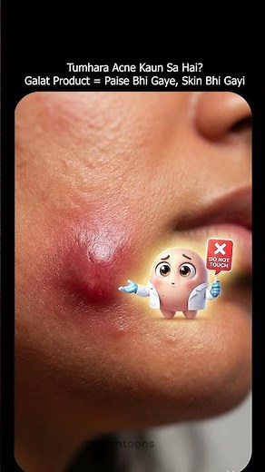 Every Pimple Needs a Different Treatment! 😳 Acne Types Explained by Dermatologist