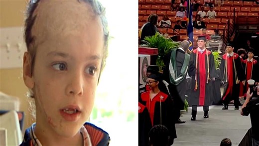 Upstate boy attacked by dog at age of 3 overcomes adversity, graduates from high school