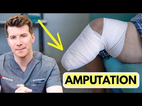 Doctor explains Limb Amputation | Procedure, recovery and more