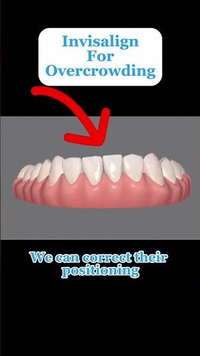 Invisalign to correct lower front teeth overcrowding