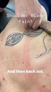 👉IASTM for Shoulder Blade Pain 😮‍💨Shoulder blade discomfort is a common issue, but the cause isn’t always straightforward. ✔️Here are a few possible reasons for scapular pain: 🔸 Rhomboid strain or trigger points 🔸 Levator scapulae overload 🔸 Thoracic joint restriction 🔸 Cervical referral (C4–C7) 🔸 Scapulothoracic movement issues 🔸 Lat dorsi compensation ✅IASTM can be a useful tool for reducing tension, improving glide, and supporting recovery when used with clear clinical reasoning. ✅We