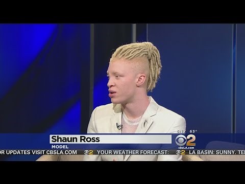 First Male Model With Albinism Says He Loves The Skin He's In