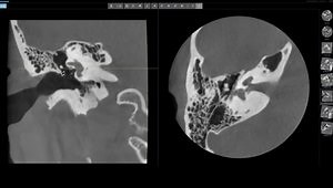 How to Read Temporal Bone Imaging