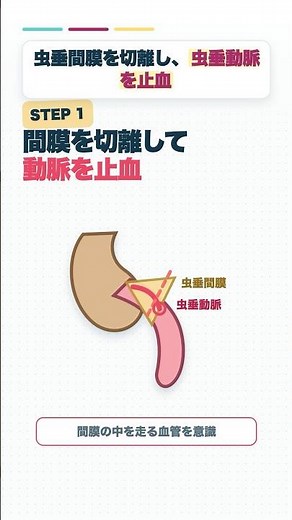 Emergency! Appendicitis Surgery! Now, How Do You React!? #OperatingRoomNurse #Nurse #Surgery #Ope...