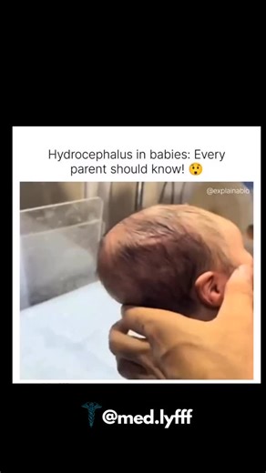 Dr. Shweta S Kasat on Instagram: "Hydrocephalus = excessive accumulation of cerebrospinal fluid (CSF) in the brain ventricles → ↑ intracranial pressure and ventricular dilatation. ⸻ 🔹 Normal CSF physiology (quick recap) • Produced by: Choroid plexus • Flow: Lateral ventricles → 3rd ventricle → Aqueduct of Sylvius → 4th ventricle → Subarachnoid space • Absorbed by: Arachnoid villi into venous system ⸻ 🔹 Types of Hydrocephalus 1️⃣ Non-communicating (Obstructive) • CSF flow blocked within ventric