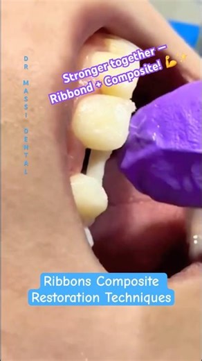 Ribbond Composite Restoration Trick 🦷
