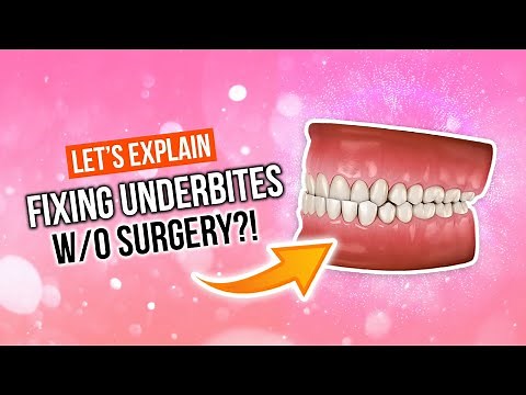 How To Fix An UNDERBITE Without Surgery!