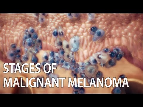 Malignant melanoma animation | skin cancer | #SkinCancer #MalignantMelanoma #MelanomaAwareness