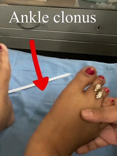 Ankle clonus