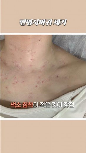 편평사마귀 100개 제거! 레이저보다 꼼꼼한 '수기 제거' 과정 (속시원함 주의)