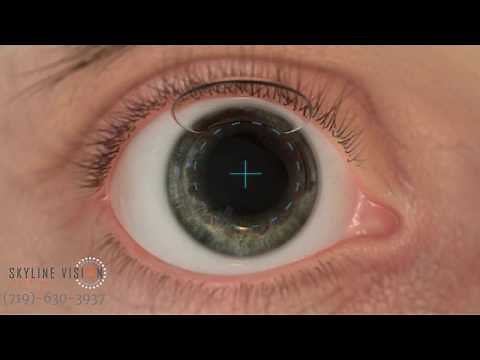 WaveLight® EX500 Excimer Laser.