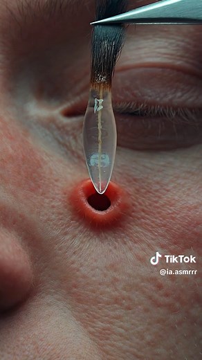 Shocking Clear Cyst Removal: Satisfying Deep Pore Reveal