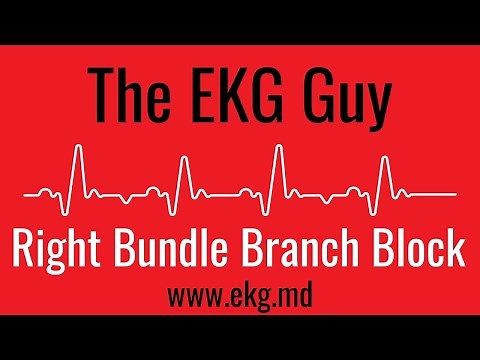 Right Bundle Branch Block (complete) on EKG / ECG l The EKG Guy - www.ekg.md