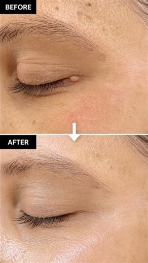 Eye Skin Tag Removal