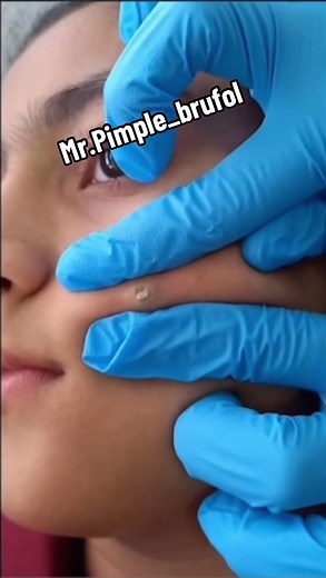 #mrpimple_brufol #brufol #mrpimple #popper #pimple #pimpleface #facepimple #pimplesandblackheads #pimplesatisfying #pimplesremover #pimples_brufoli_ #pimplesonmyface #pimplesss #pimplepopperaddict #pimpletop #pimples_brufoli #pimplessatisfy #pimpleforever #cravosgigantes #pimplepus #zits #blackhead #fyp #fypシ #fypシ゚viral #foryoupage #foryou