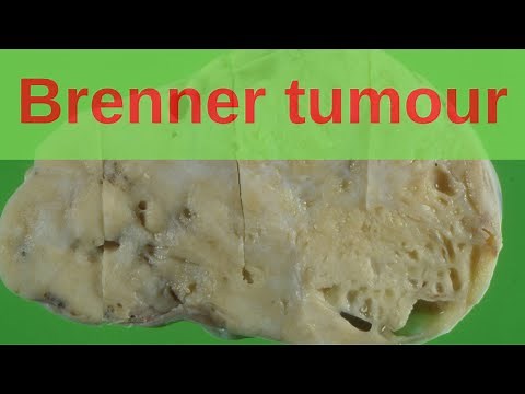 Brenner Tumour of the Ovary - Pathology mini tutorial