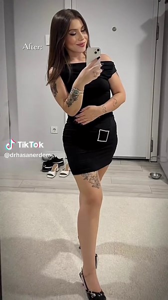 Gastric Sleeve Surgery: Before and After Transformation