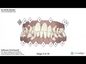 Clincheck Invisalign - Vídeo en 3D