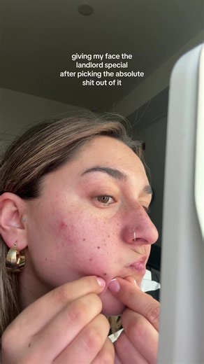 Concealer Tricks for Covering Blackheads and Freckles