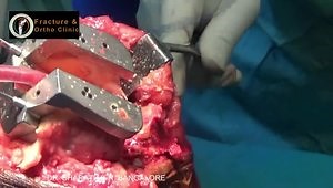 Lateral Parapatellar Approach to Severe Valgus Deformity - No Use of Semiconstrained Implants