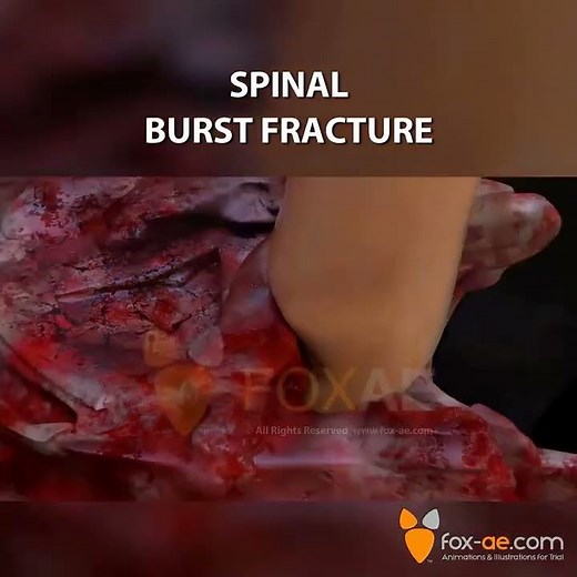 Spinal Burst Fracture