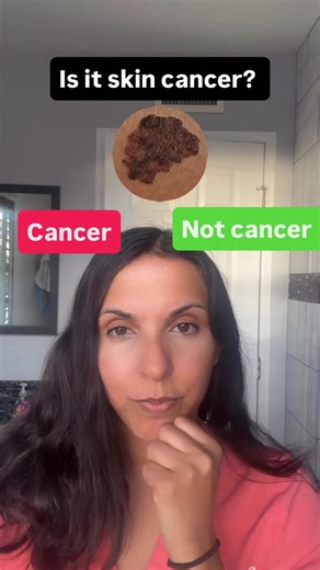 Understanding Melanomas and Seborrheic Keratosis