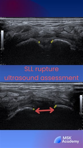 MSK Australia on Instagram: "🖐️ Scapholunate ligament on ultrasound Focus on the dorsal scapholunate ligament - the strongest and most clinically important component. Using a high-frequency linear probe over the dorsal wrist, a normal ligament appears as a continuous fibrillar band between the scaphoid and lunate. ⚠️ Tear signs: loss of fibrillar pattern, hypoechoic gap, or widening of the scapholunate interval, often more evident on dynamic scanning. Dorsal ligament disruption is the key drive