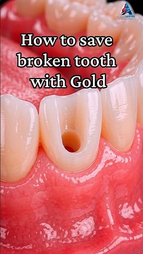 How actually fixed a Broken Tooth with a Post & Gold Crown | dentists use gold crowns