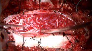 #282: Resection of a Cervical-Thoracic Intramedullary Spinal Cord Arteriovenous Malformation - Arteriovenous Malformation - Seven Series Collection